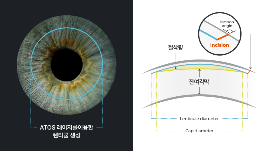 스마트라식? 스마일라식?