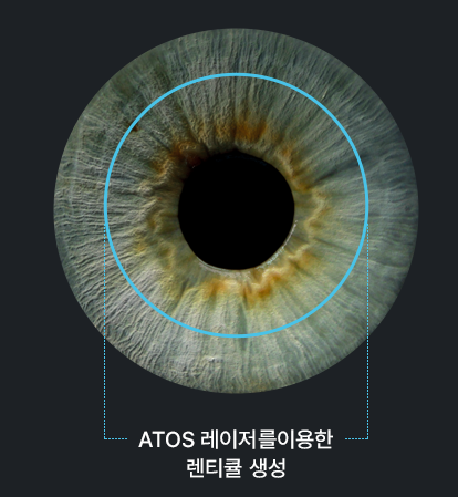 Smart Nova cũng là mổ SMILE LASIK phải không?